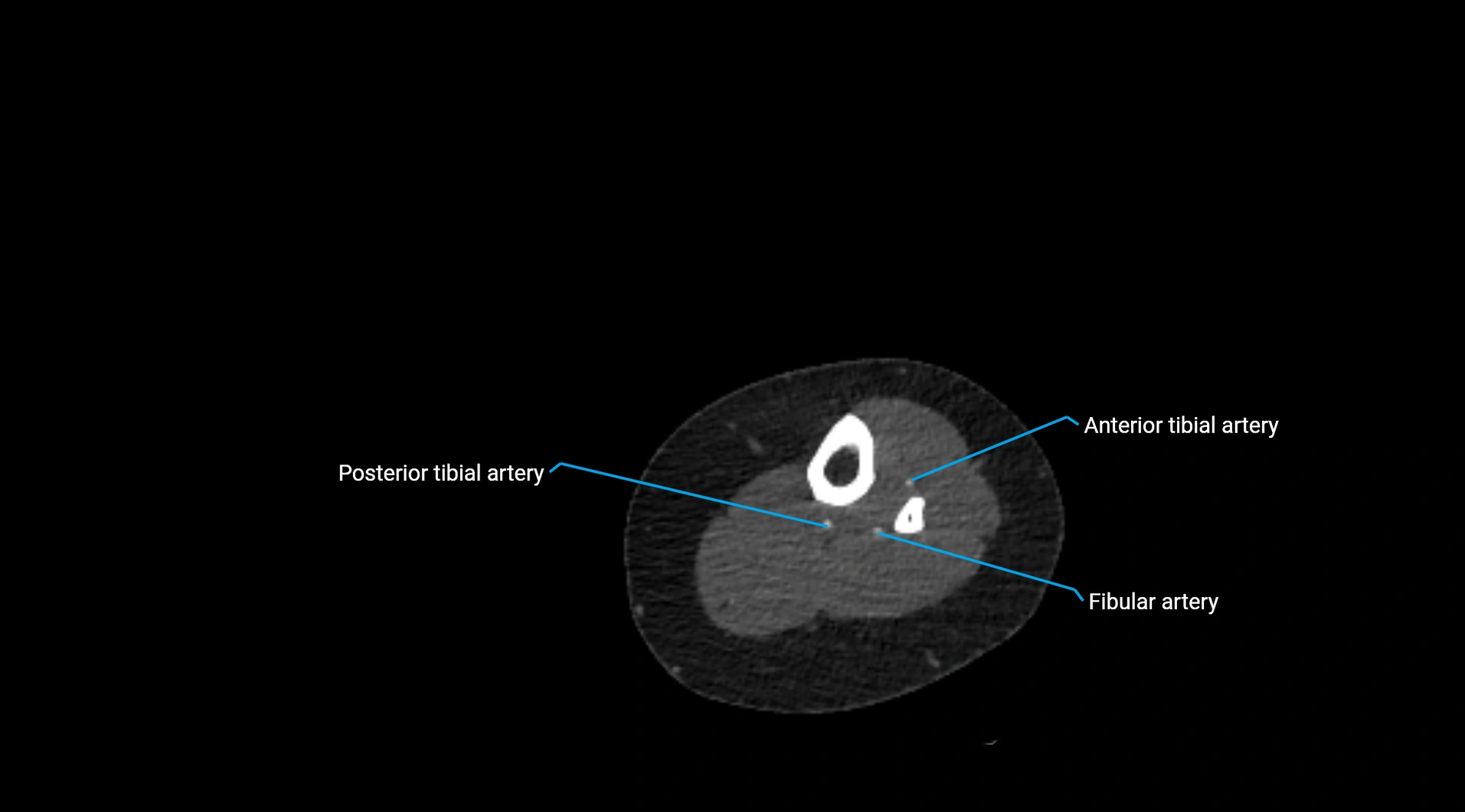 CTA lower limb cross sectional anatomy labelled image _213.webp